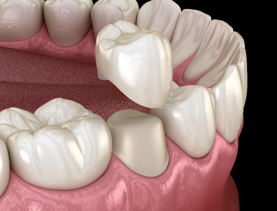 dental crown on tooth | dental crown scaroborough