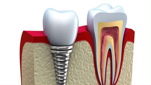 An illustration of a Dental Implants in Scarborough, ON