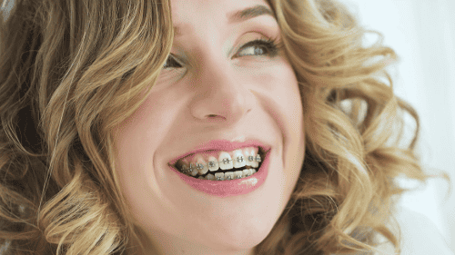 A woman smiling after getting Orthodontic Braces in Scarborough, ON