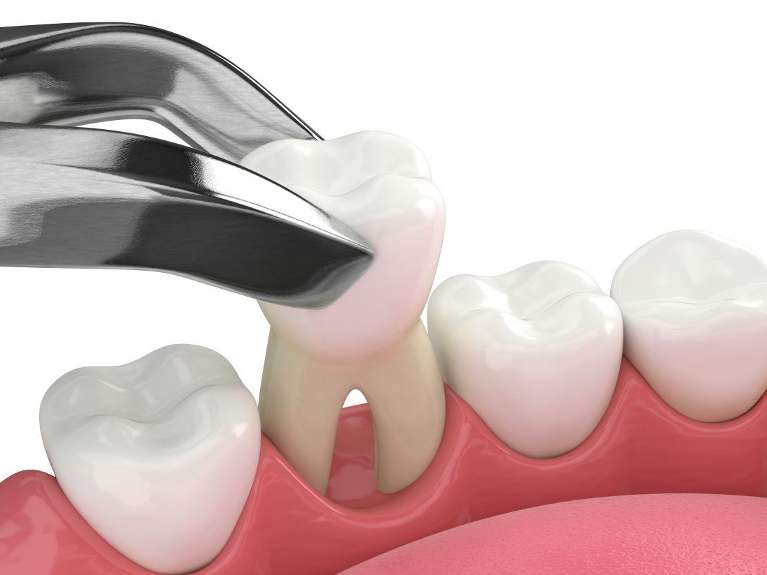 dental tool extracting tooth | tooth extraction scarborough on