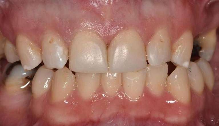 Anterior-Teeth-Restored-With-Tooth-Colour-Restorations-After-Image