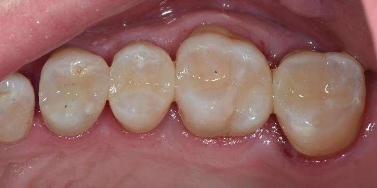 An after picture teeth with a durable and aesthetic alternative—tooth-coloured composite resin fillings.