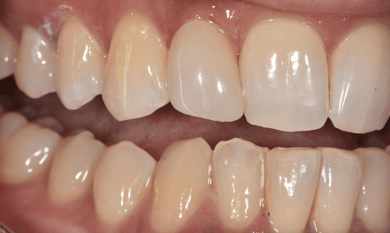 An after picture of teeth after getting a Single-Tooth Composite Veneer
