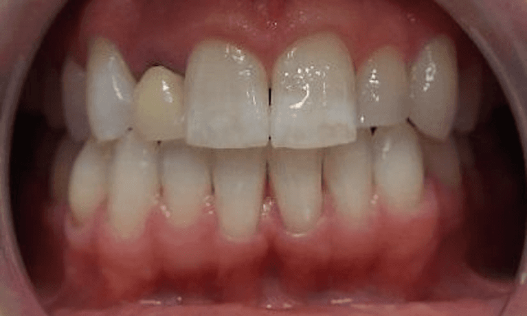 All-Ceramic-Metal-Free-Dental-Crown-Before-Image