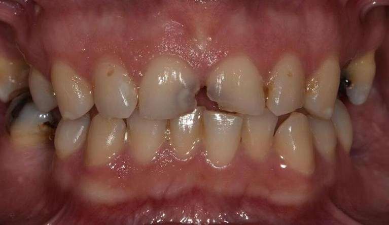 Anterior-Teeth-Restored-With-Tooth-Colour-Restorations-Before-Image