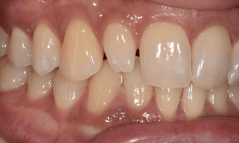 A before picture before getting a Single-Tooth Composite Veneer