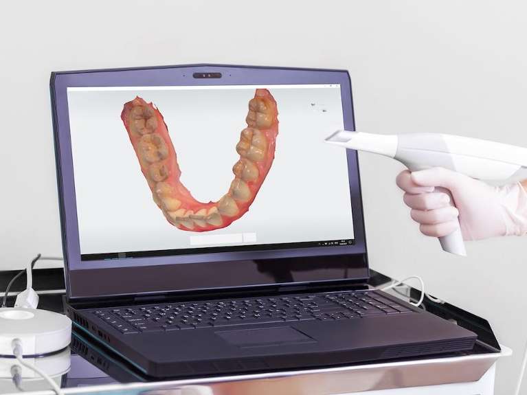digital impressions | dental crowns scarborough